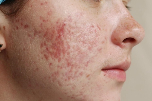 Стойкая эритема (постакне)