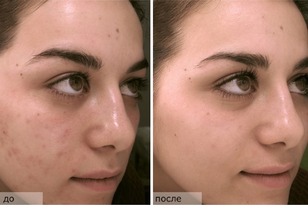 Результат медикаментозного лечения постакне