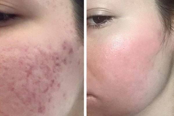 Лазерная шлифовка постакне