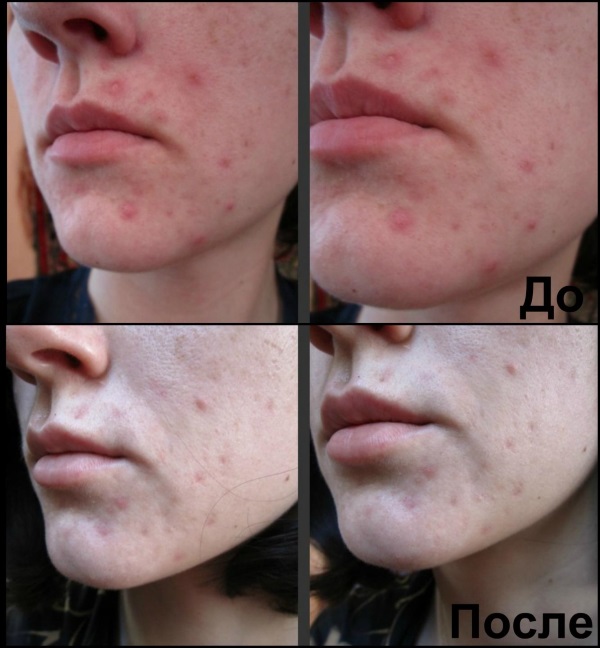 Результат применения синтомициновой мази