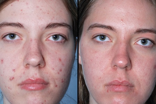 Результат применения переливания крови при прыщах