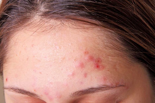 Прыщи на лбу