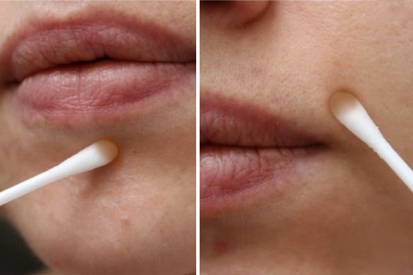 Обработка прыщей лосьоном