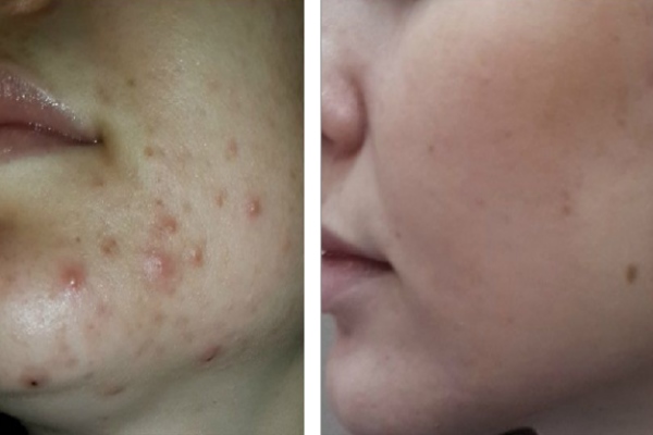 Результат использования лосьона от прыщей