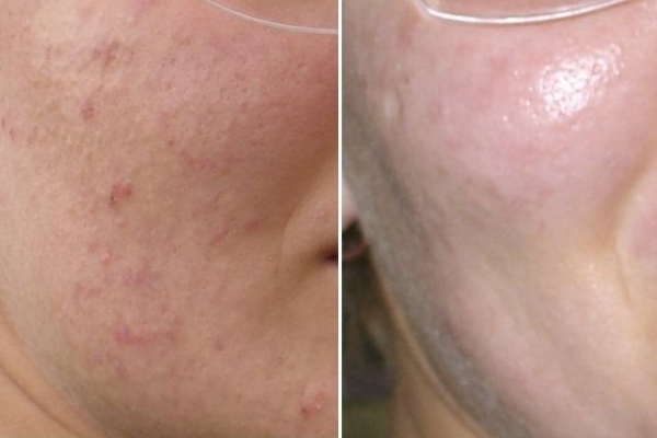 До и после использования Метрогила