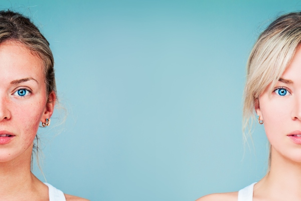 Избавление от прыщей народными способами