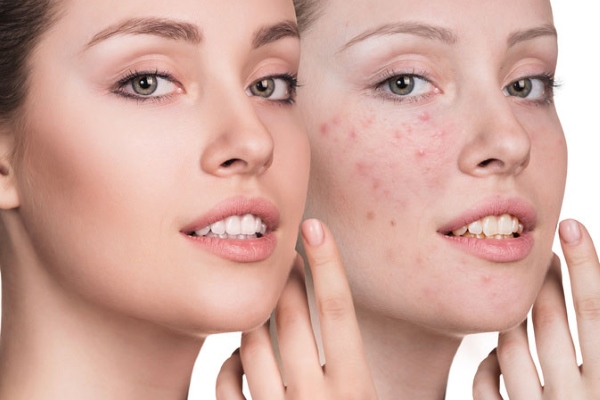 Аспирин от прыщей