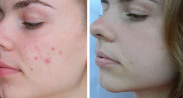 Результат использования борной кислоты от прыщей