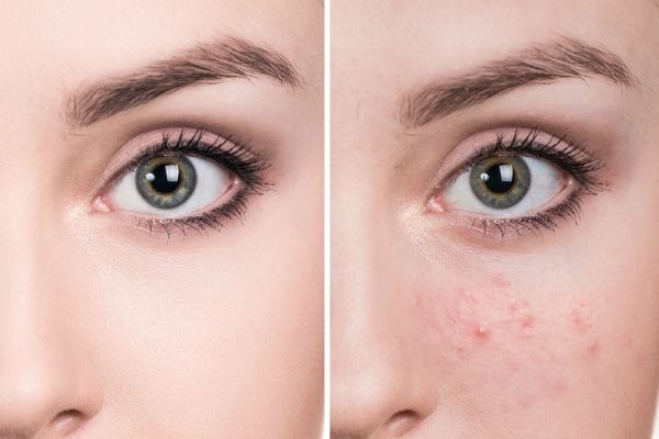 Избавление от прыщей с помощью Хлоргексидина