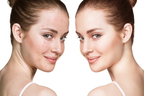 Ретиноиды от прыщей