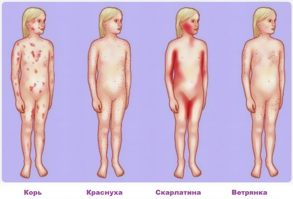 Различные инфекционные высыпания