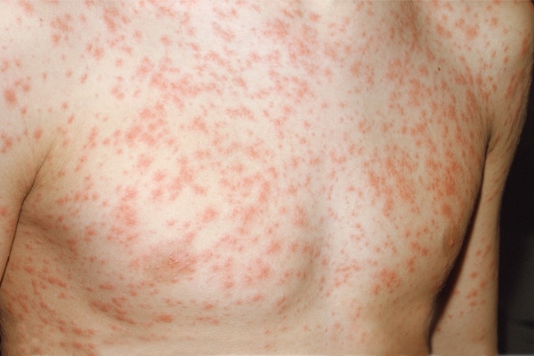 Инфекционный дерматит