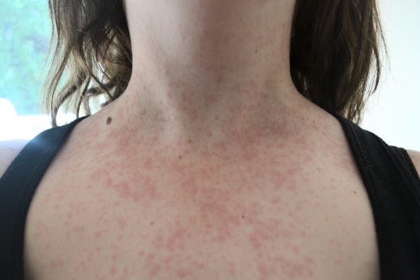 Инфекционно-аллергический дерматит