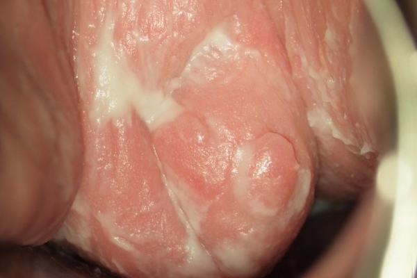 Кандидоз влагалища