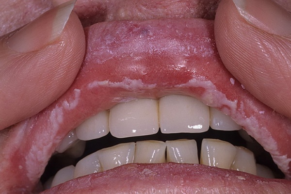 Молочница во рту