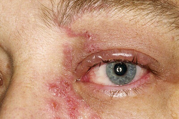 Грибок глаз