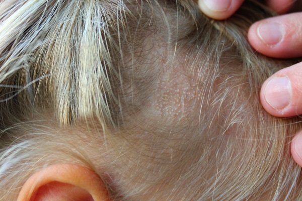 Трихофития