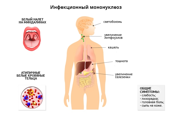 Симптомы инфекционного мононуклеоза