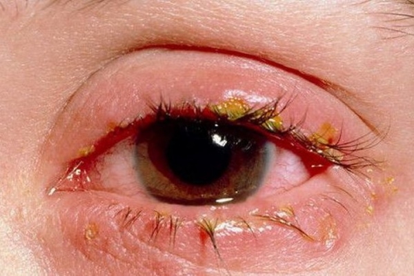 Пораженный инфекционным конъюнктивитом глаз