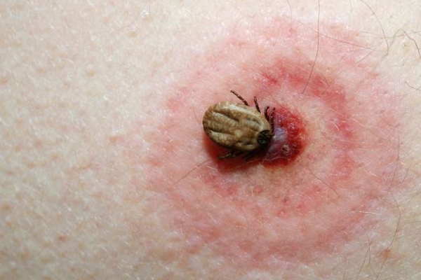 Клещ укусил