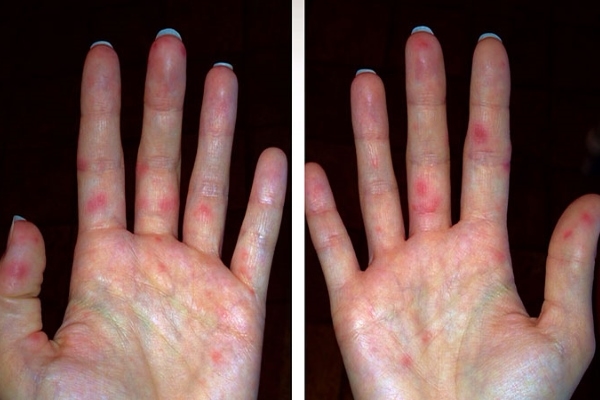 Сыпь при энтеровирусной инфекции