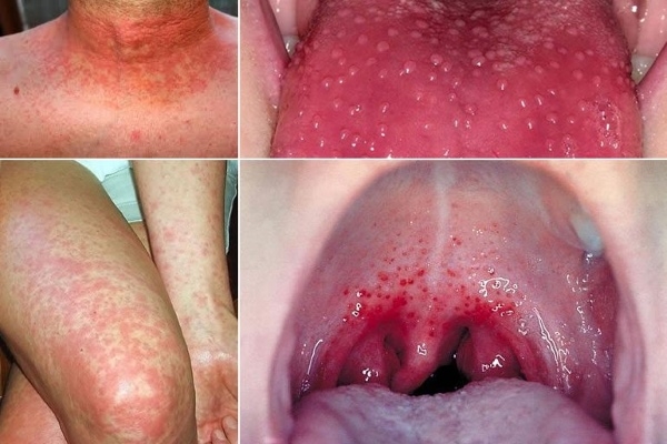 Стрептококк