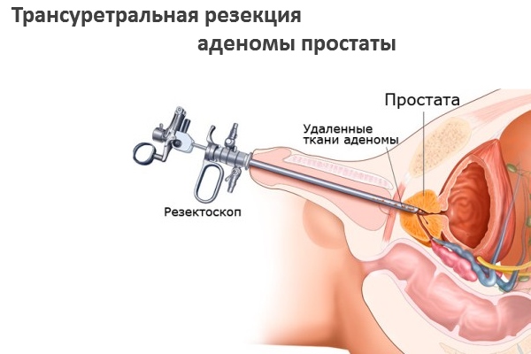 Трансуретральная резекция аденомы простаты