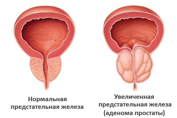 Аденома простаты