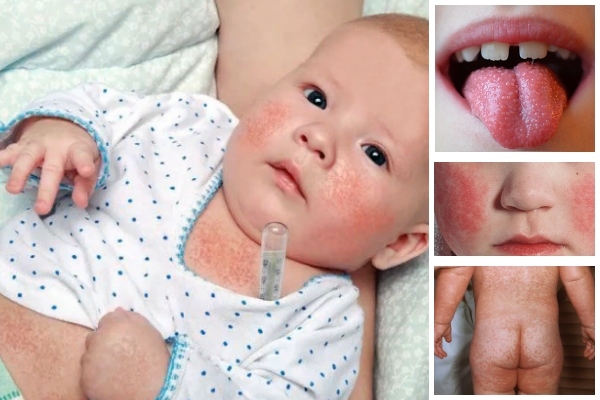 Скарлатина