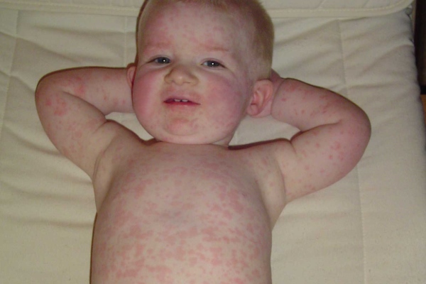 Краснуха у ребенка