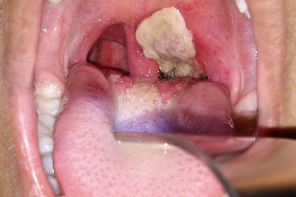 Дифтерийная пленочка