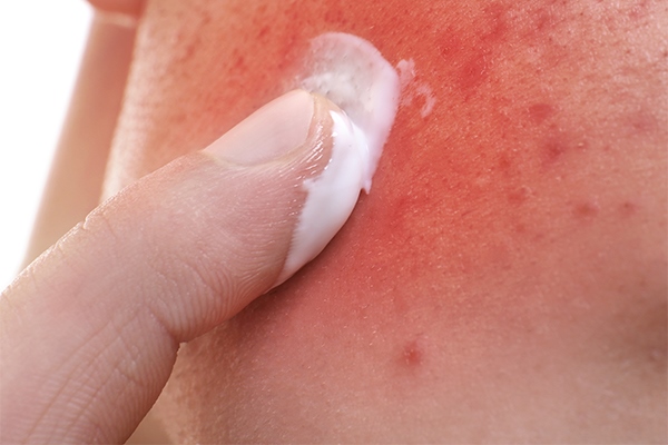 Аллергия на детский крем