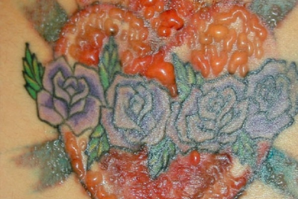 Пузырьковая сыпь