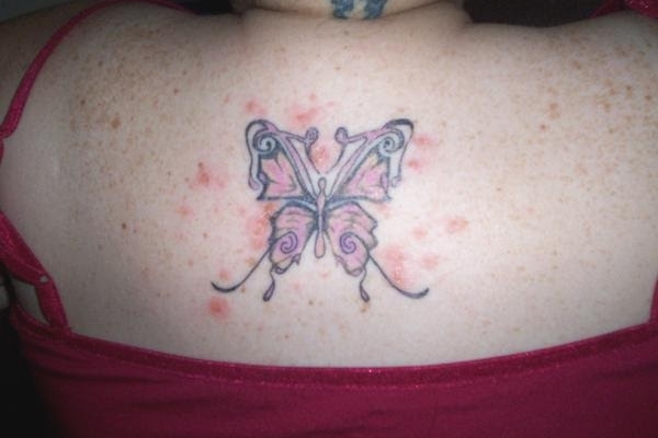 Прыщи на зажившей тату