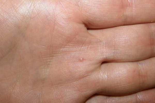 Водянистый прыщ