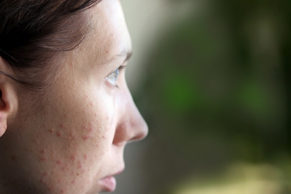 Аллергические прыщи