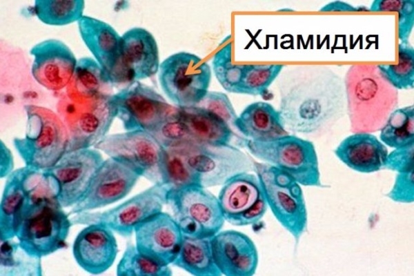 Хламидия