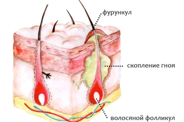 Наглядный пример воспаленного фурункула