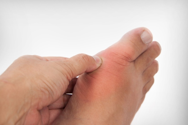 Подагрический артрит