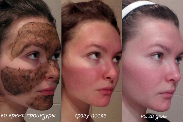 Эффект от бадяги