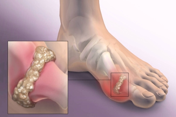 Артрит на стопе