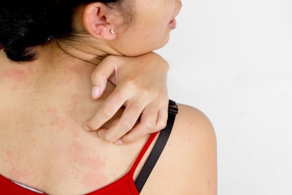 Зудящая сыпь