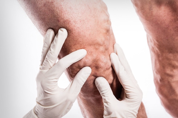 Тромбофлебит при варикозе