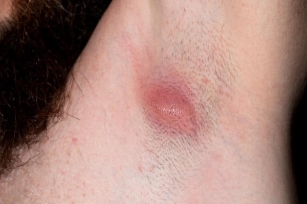 Прыщи от эндокринных нарушений