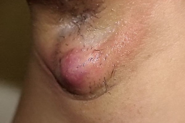 Гидраденит