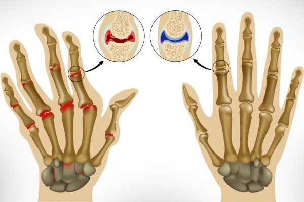 Полиартрит суставов