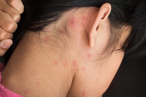 Прыщи на затылке