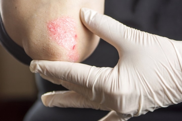 Прыщи на локте