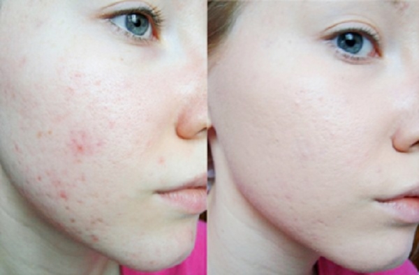 До и после лечение вульгарных прыщей 1