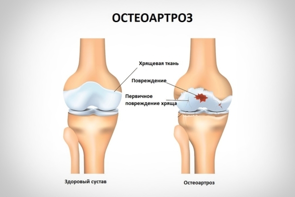 Остеоартроз